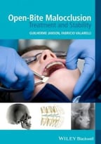 Open-Bite Malocclusion: Treatment And Stability
