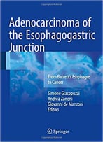 Adenocarcinoma Of The Esophagogastric Junction: From Barrett's Esophagus To Cancer